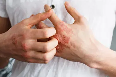 Piele predispusă la eczemă