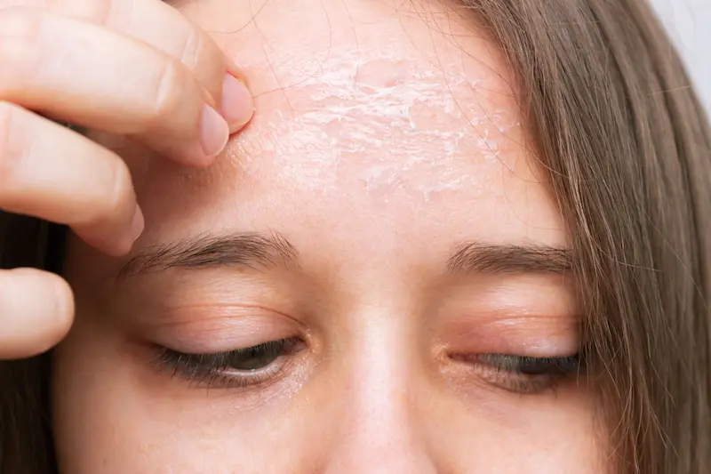 Piele predispusă la eczemă - 1