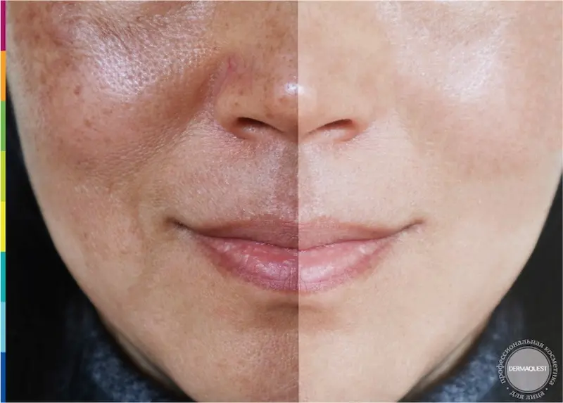 Piele cu exces de sebum și luciu